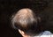 Thinning or sparse hair, male pattern hair loss