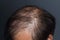 Thinning or sparse hair, male pattern hair loss