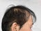 Thinning or sparse hair, male pattern hair loss in Asian, Chinese elder man