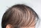 Thinning or sparse hair, male pattern hair loss in Asian elder man