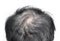 Thinning or sparse hair, male pattern hair loss in Southeast Asian, Chinese elder man