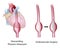 Thoracic aortic aneurysm