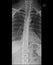 Thoracic spine x-ray. Anteroposterior view.