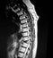 Thoracic vertebrae pathological body compression mri