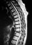 Thoracic vertebrae pathological body compression mri