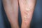 Thrombophlebitis in human leg