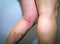 Thrombophlebitis in human leg