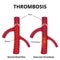 Thrombus formation