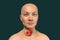 Thyroid cancer, 3D illustration