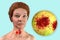 Thyroid cancer, 3D illustration showing thyroid gland with tumor