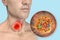Thyroid cancer, 3D illustration showing thyroid gland tumor