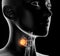 Thyroid cancer of a woman, medically 3D illustration on black background