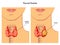 Thyroid nodule