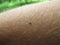 Tick on arm