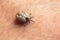 A tick drunk on blood crawls on human skin