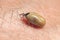 A tick drunk on blood crawls on human skin