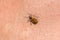 Tick filled with blood crawling on human body skin