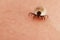 Tick on human skin