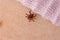 Tick on human skin. Carrier of infections of encephalitis. Parasite mite crawling under clothes. Ixodes ricinus. Biting insect