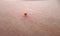 Tick with its chelicerae sticking in human skin. Human macro skin texture
