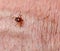 Tick on Skin