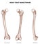 Tight bone- Femur