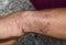 Tinea manus or Fungal Infection on wrist of Southeast Asian, Burmese adult man.