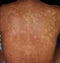 Tinea versicolor, Pityriasis versicolor skin infection on the back is a type of fungal disease caused by Malassezia spp.,