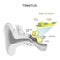 Tinnitus. Human ear