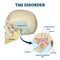 TMJ disorder vector illustration. Labeled jaw condition educational scheme.