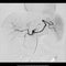 TOCE or Transcatheter Oily Chemo Embolization