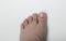 Toe with a buried and separate completely full of fungus known as: onychomycosis