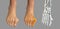 Toe deformation, also known as hallux valgus, or bunion