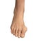 Toe deformation, also known as hallux valgus, or bunion