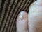 A toe nail with Onychomycosis - fungal infection of the nail