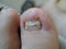 A toe nail with Onychomycosis - fungal infection of the nail