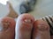 A toe nail with Onychomycosis - fungal infection of the nail