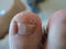 A toe nail with Onychomycosis - fungal infection of the nail