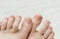 Toenail fungus.Women`s feet on a white towel. Nail problems.Hand and foot care.Beriberi and injuries