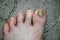 Toenails affected by an infectious disease.Fungal infection of the nail plate.