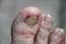 Toenails affected by an infectious disease.Fungal infection of the nail plate.