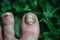 Toenails affected by an infectious disease.Fungal infection of the nail plate.