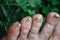 Toenails affected by an infectious disease.Fungal infection of the nail plate.