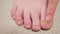 Toenails with fungal infection and bruise on big toe macro