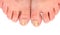 Toenails infected with fungus