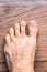 Toes affected by dermal problems, red rash produced plaques of psoriasis