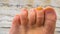 Toes in close up with a fungus infected nail, Common infection and disease