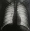 Tomography of human chest no pathologies