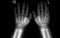 Tomography of toddler hands. no pathologies