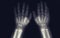 Tomography of toddler hands. no pathologies